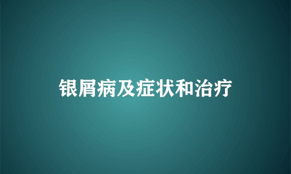 银屑病及症状和治疗
