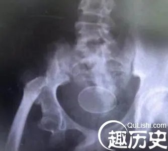 12岁男童离奇产蛋：一连产14颗究竟为何？