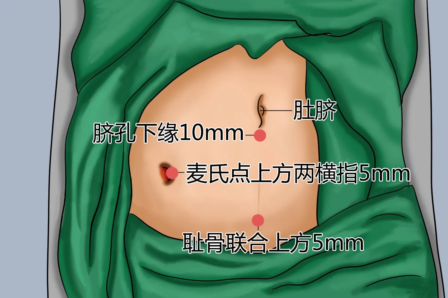 阑尾炎手术图片