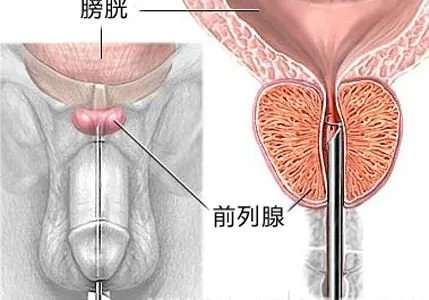 北京前列腺症状及治疗?