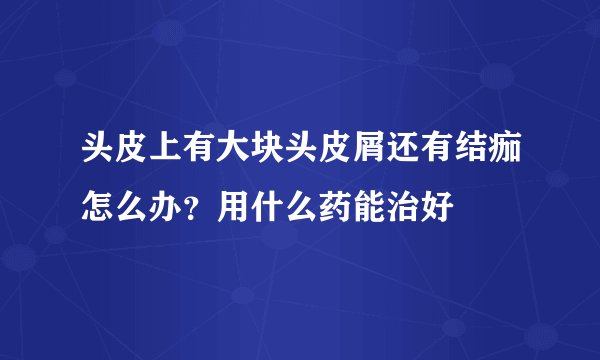 头皮上有大块头皮屑还有结痂怎么办？用什么药能治好