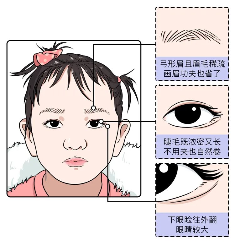 长得太漂亮也是病?歌舞伎面谱综合征,一种美得像洋娃娃的遗传病