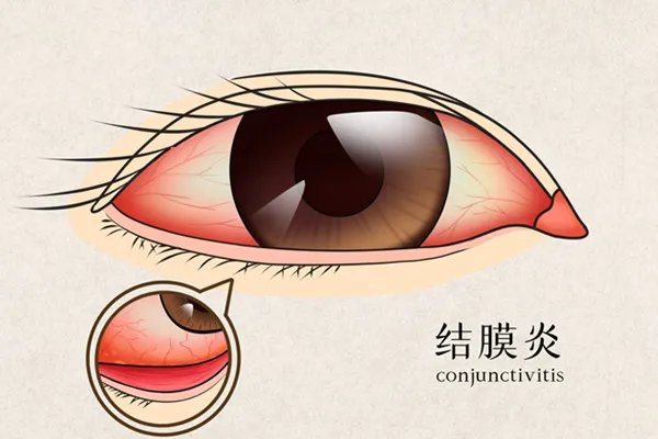 眼屎多怎么办