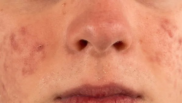 黑色痘印怎么消除