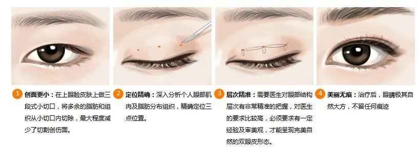 定点双眼皮的手术过程及原理是什么？