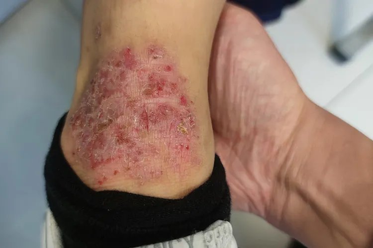 儿童湿疹的症状和图片