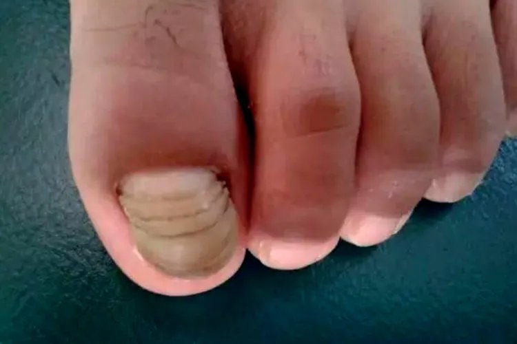 脚趾甲横纹断层图片