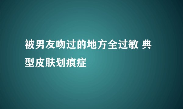 被男友吻过的地方全过敏 典型皮肤划痕症