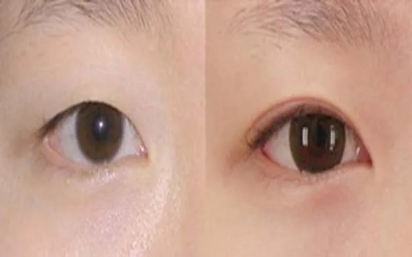 切开双眼皮整形北京哪家医院好？
