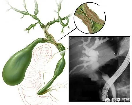 《金粉世家》的导演李大为因罹患胆管细胞癌去世,这种癌症很难治吗?