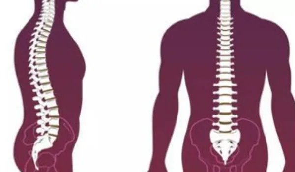 李宇春患了强直性脊柱炎,被称为不死的癌症,这种病真的很可怕吗?