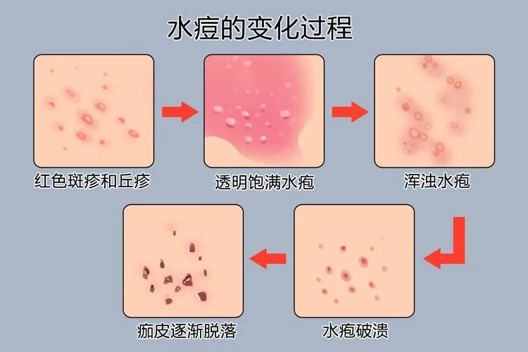 水痘过程图片