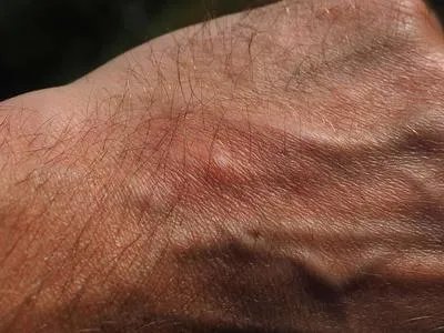 保德路皮肤病医院门诊时间 皮肤病的保健方法介绍