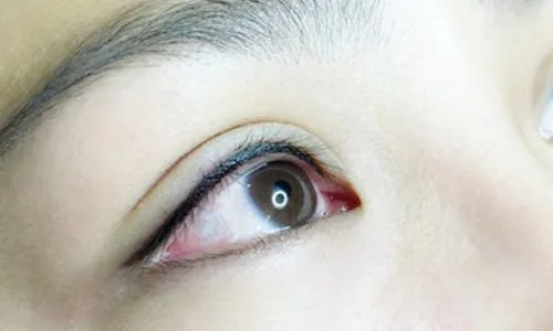 韩式埋线双眼皮价钱