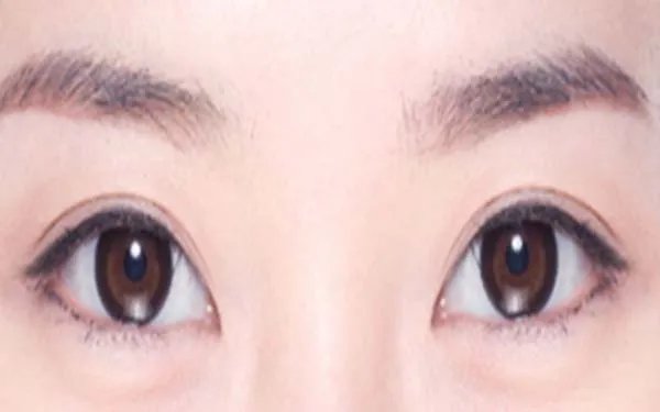 上海哪几家整形医院双眼皮做的好
