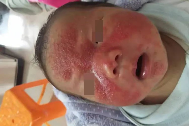 下巴和鼻子周围长小颗粒图片
