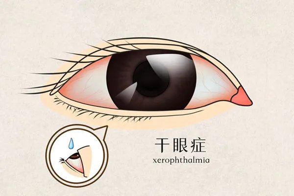 眼屎多怎么办