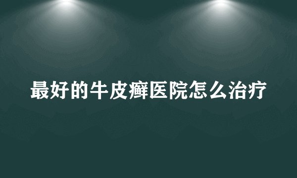 最好的牛皮癣医院怎么治疗
