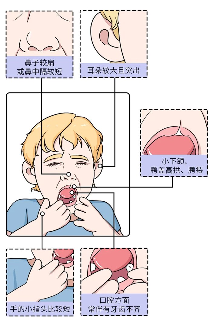 长得太漂亮也是病?歌舞伎面谱综合征,一种美得像洋娃娃的遗传病