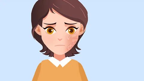 牛皮藓治疗方法