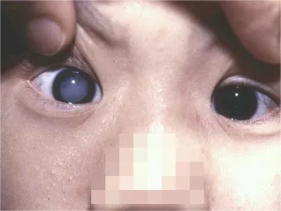 先天性风疹综合征症状图片