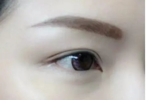 眼角除皱大概多少钱