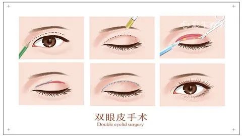 割双眼皮的坏处