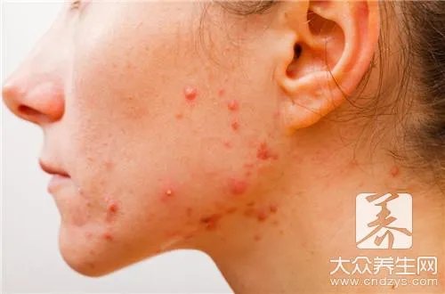 治玫瑰痤疮最好方法有哪些呢?