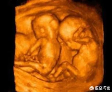 怀了双胞胎，他们会在妈妈肚子里打架吗？