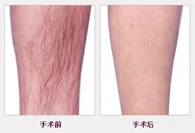 激光脱毛痛吗