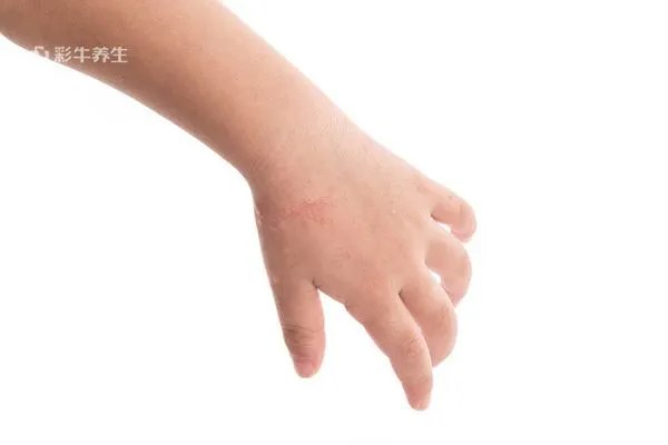 婴儿湿疹症状图片 婴儿湿疹的症状表现