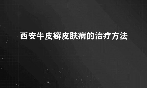 西安牛皮癣皮肤病的治疗方法