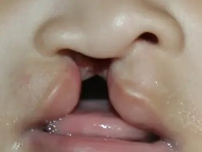 先天性风疹综合征症状图片