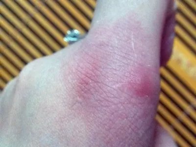 蚁蜇伤手部丘疹图片