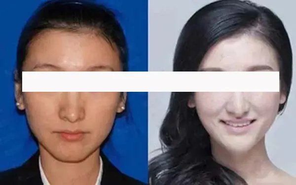 做像素激光费用花多少