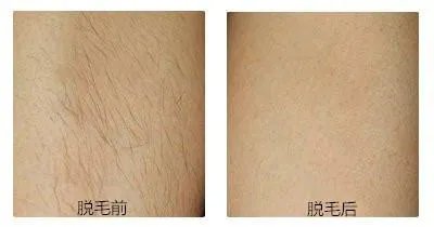 激光脱毛痛吗