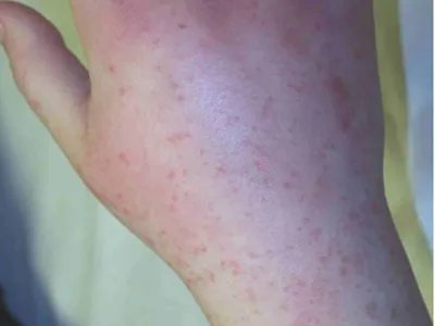 先天性风疹综合征症状图片