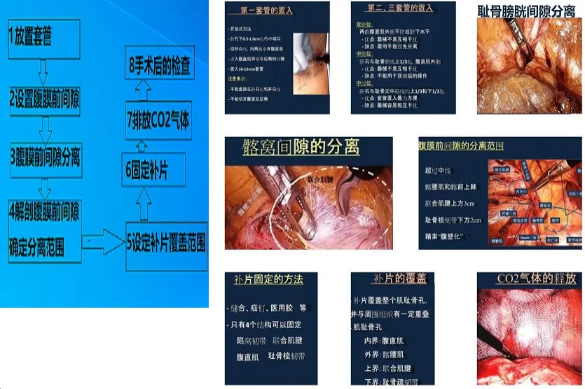 TEP手术步骤图谱
