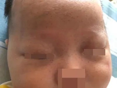 先天性风疹综合征症状图片