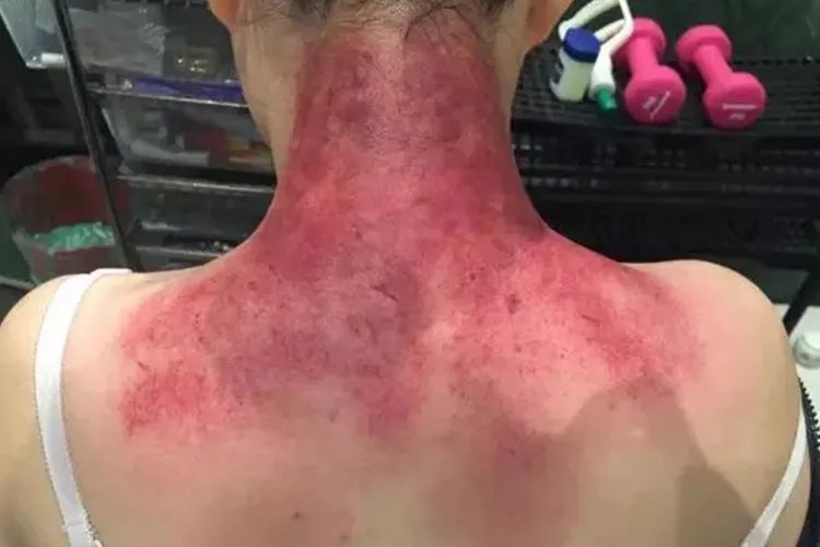 拔罐后皮肤颜色鉴别图片大全