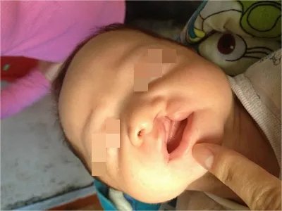先天性风疹综合征症状图片