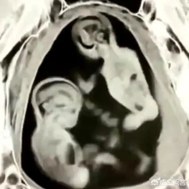怀了双胞胎，他们会在妈妈肚子里打架吗？