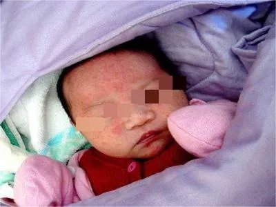 先天性风疹综合征症状图片