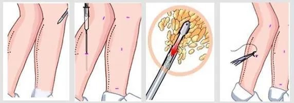 怎么减大腿怎样减大腿