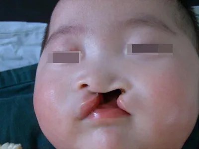 先天性风疹综合征症状图片