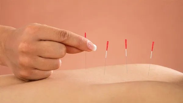 中医针灸减肥效果好不好？中医针灸减肥要牢记这5大注意事项