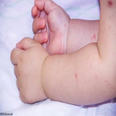 儿童痒疹是怎么引起的 这三个是儿童痒疹的“幕后黑手”
